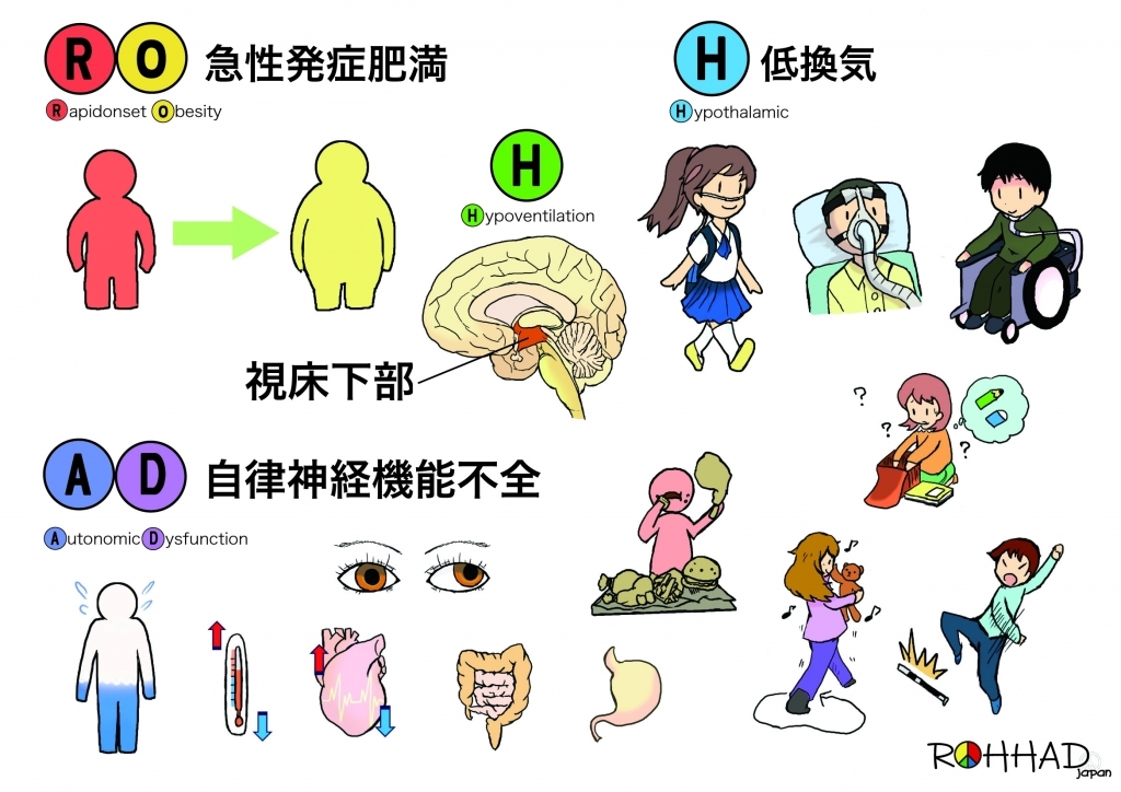 ROHHAD症候群について